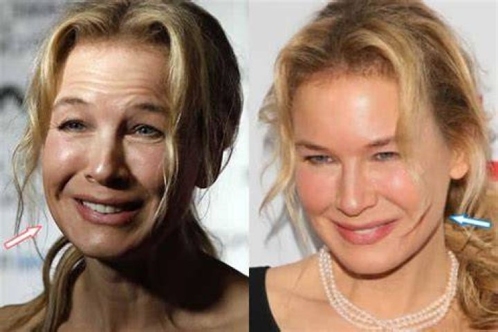 Renee Zellweger Plastic Surgery Interview