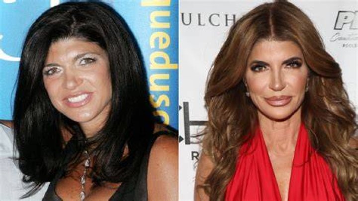 Teresa Giudice plastic surgery